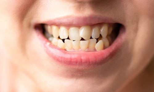 dientes-torcidos-edited