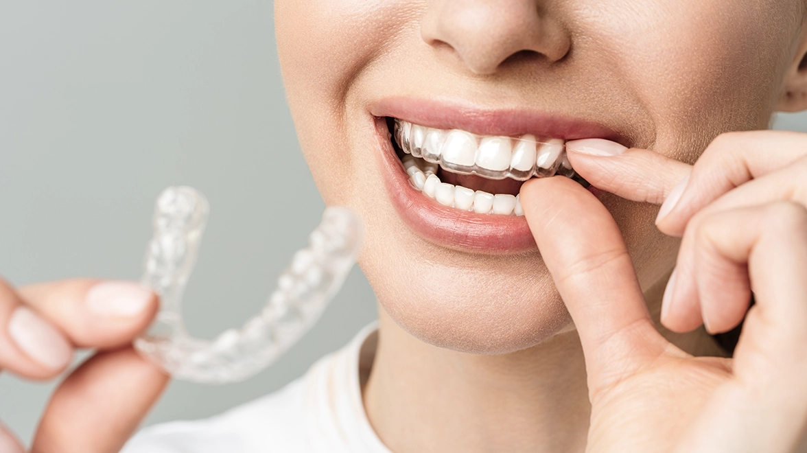 665f28a1a10aafce17628812_conmimo-innovaciones-ortodoncia-invisible