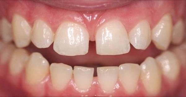 Conoce-por-que-se-separan-los-dientes