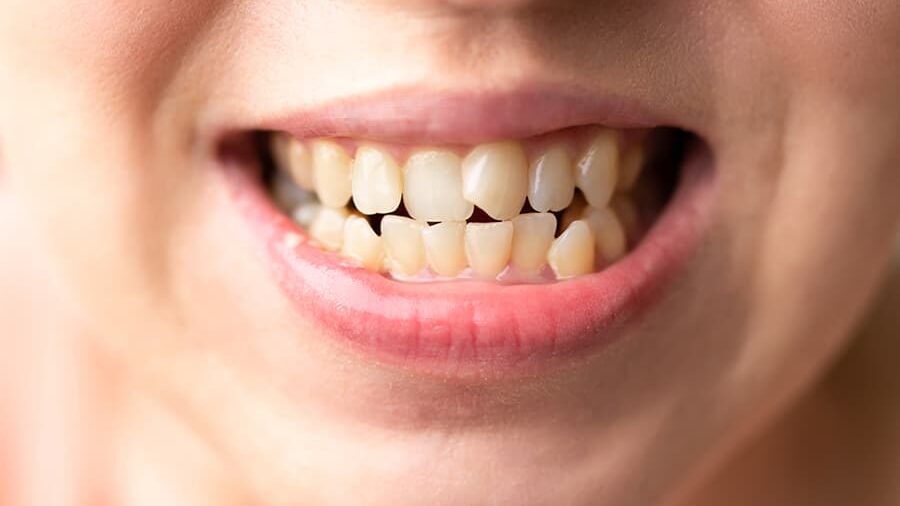 dientes-torcidos-edited